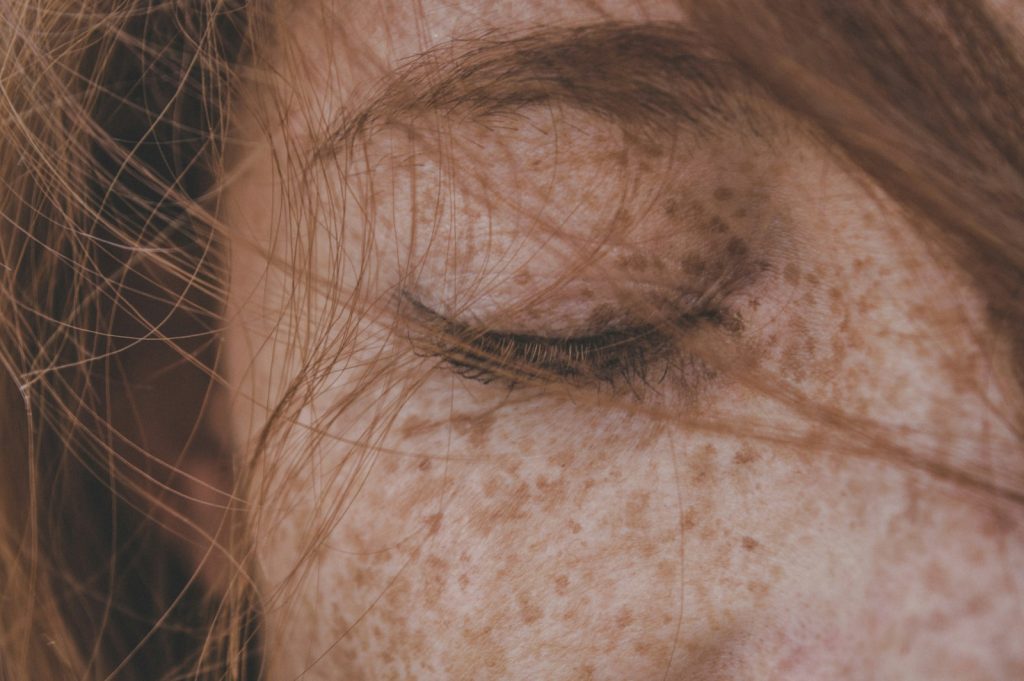korean skincare and freckles